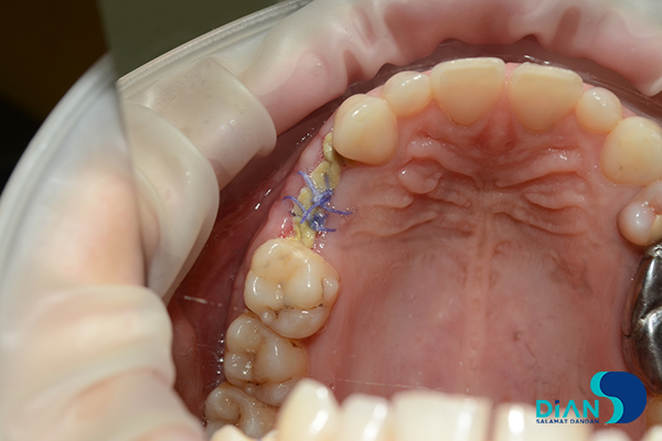 Implantation on the Maxilla