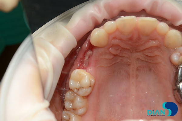 Implantation on the Maxilla