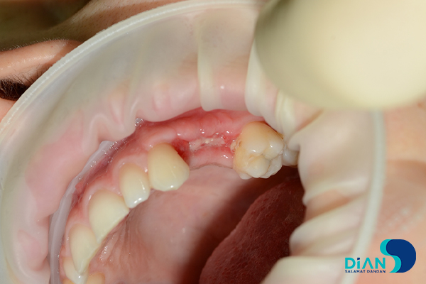 Implantation on the Maxilla