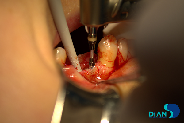 Implantation on the Maxilla