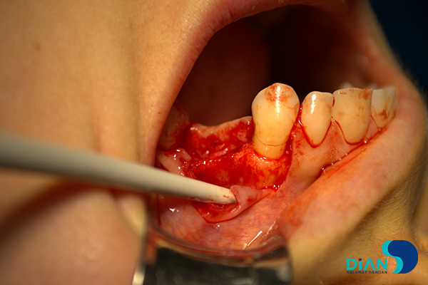 Implantation on the Maxilla