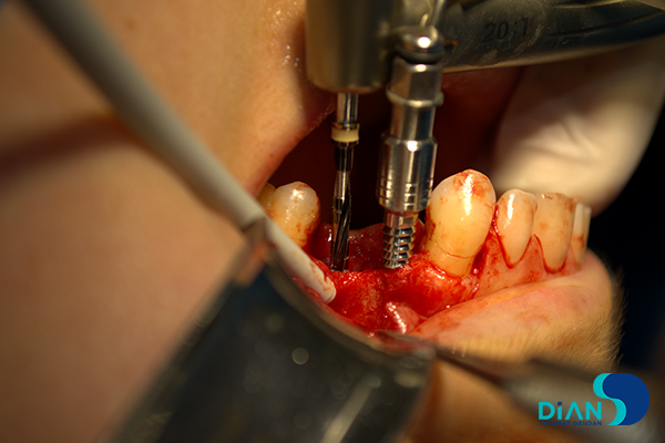 Implantation on the Maxilla