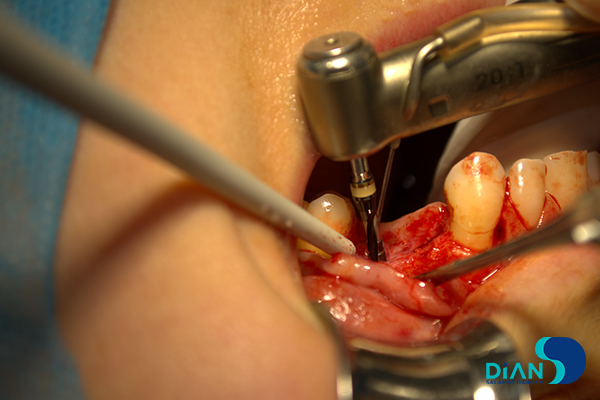 Implantation on the Maxilla