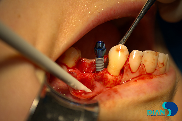 Implantation on the Maxilla