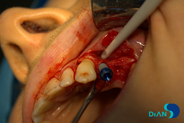 Implantation on the Maxilla