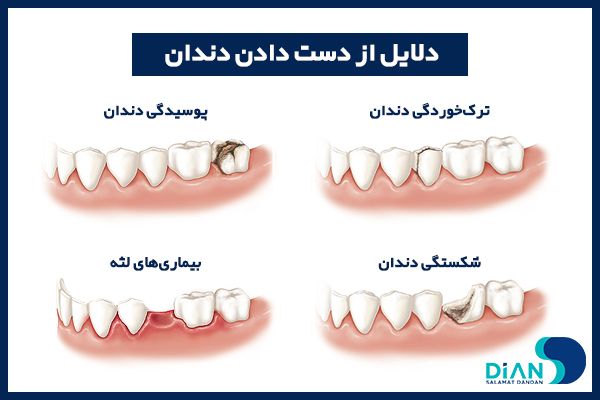 کاندید ایمپلنت دندان جلو 