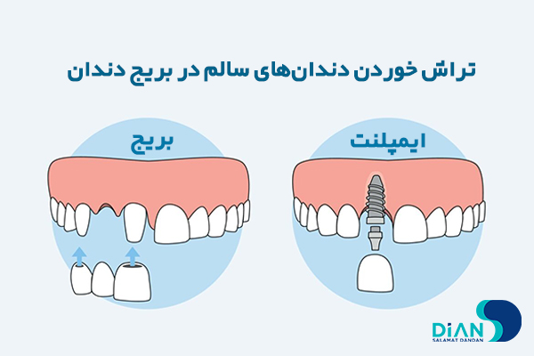 مزایای ایمپلنت دندان جلو