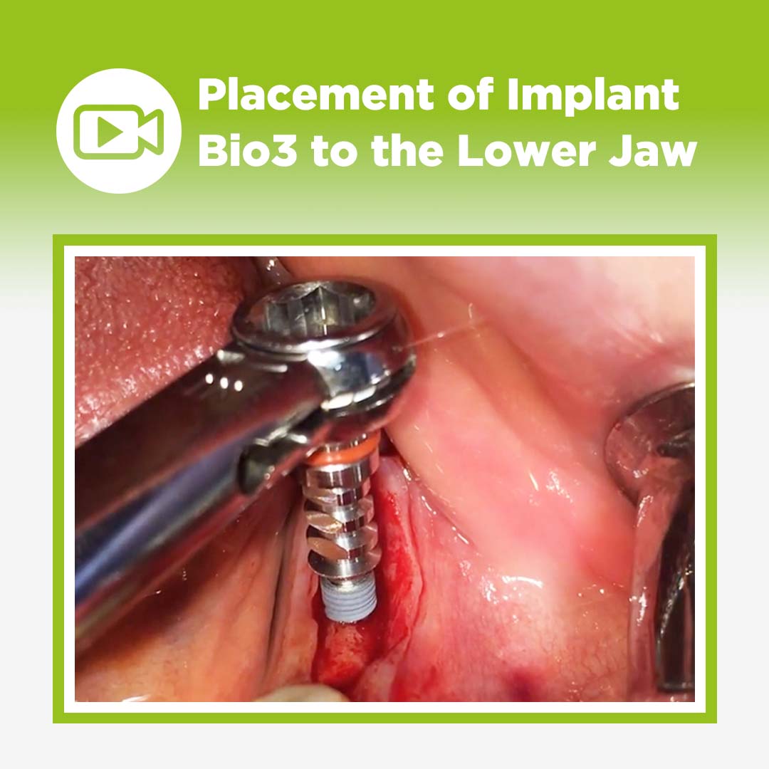 Bio3 to the Lower Jaw