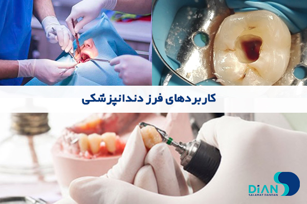 کاربردهای فرز دندانپزشکی