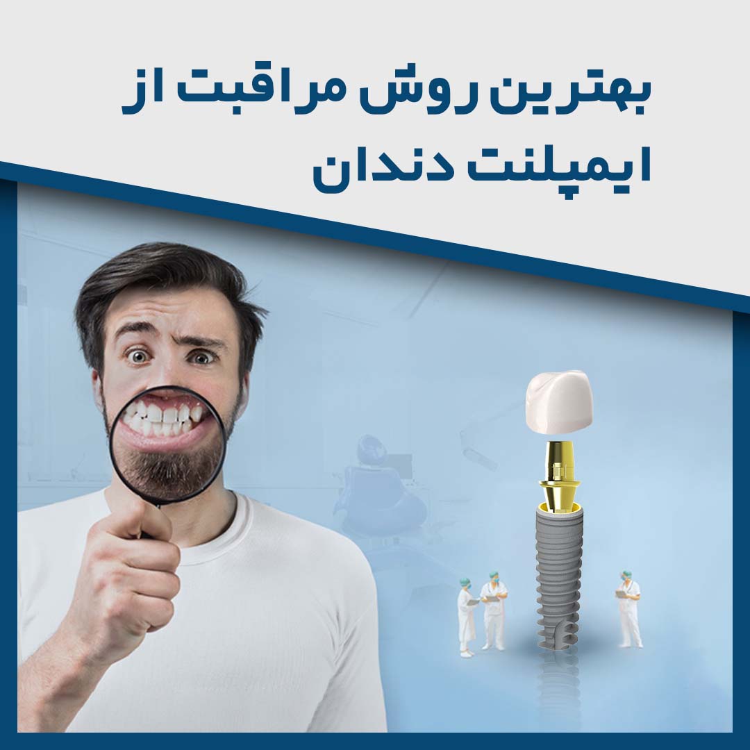 بهترین روش مراقبت از ایمپلنت دندان