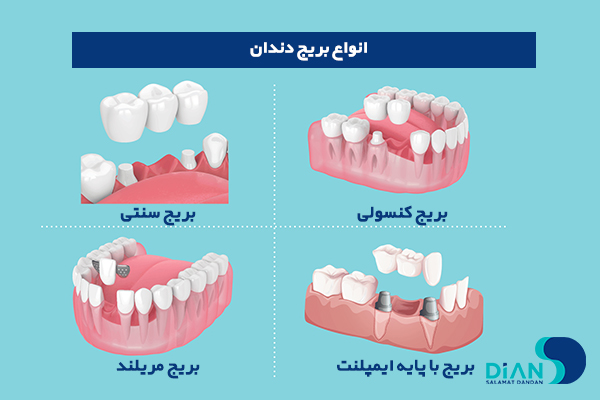 انواع بریج دندان