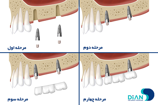 مراحل بریج بر پایه ایمپلنت