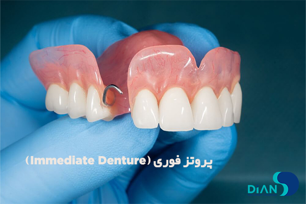 پروتز فوری (Immediate Denture)