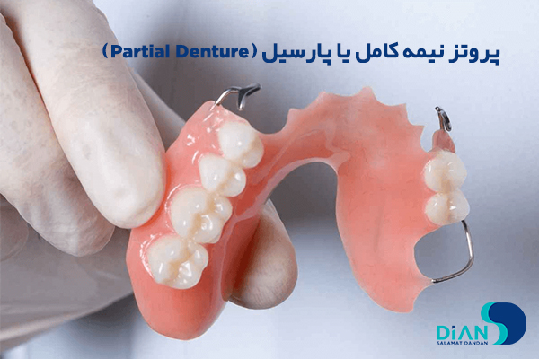 پروتز نیمه کامل یا پارسیل (Partial Denture)