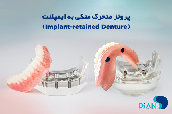 پروتز متحرک متکی به ایمپلنت (Implant-retained Denture)