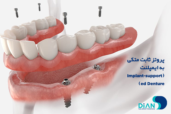 پروتز ثابت متکی به ایمپلنت (Implant-supported Denture)