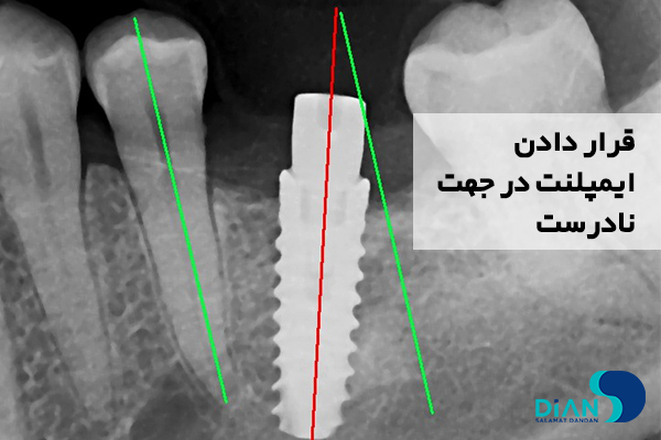 قرار دادن ایمپلنت در جهت نادرست