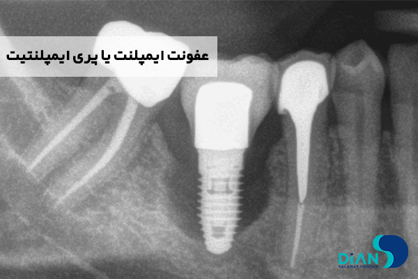 عفونت ایمپلنت یا پری ایمپلنتیت