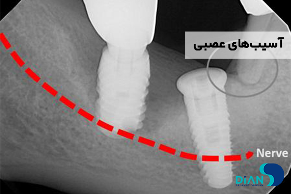 آسیب‌های عصبی