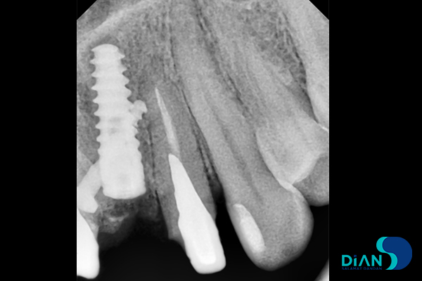 Immediate Implantation