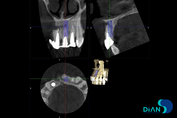 Immediate Implantation