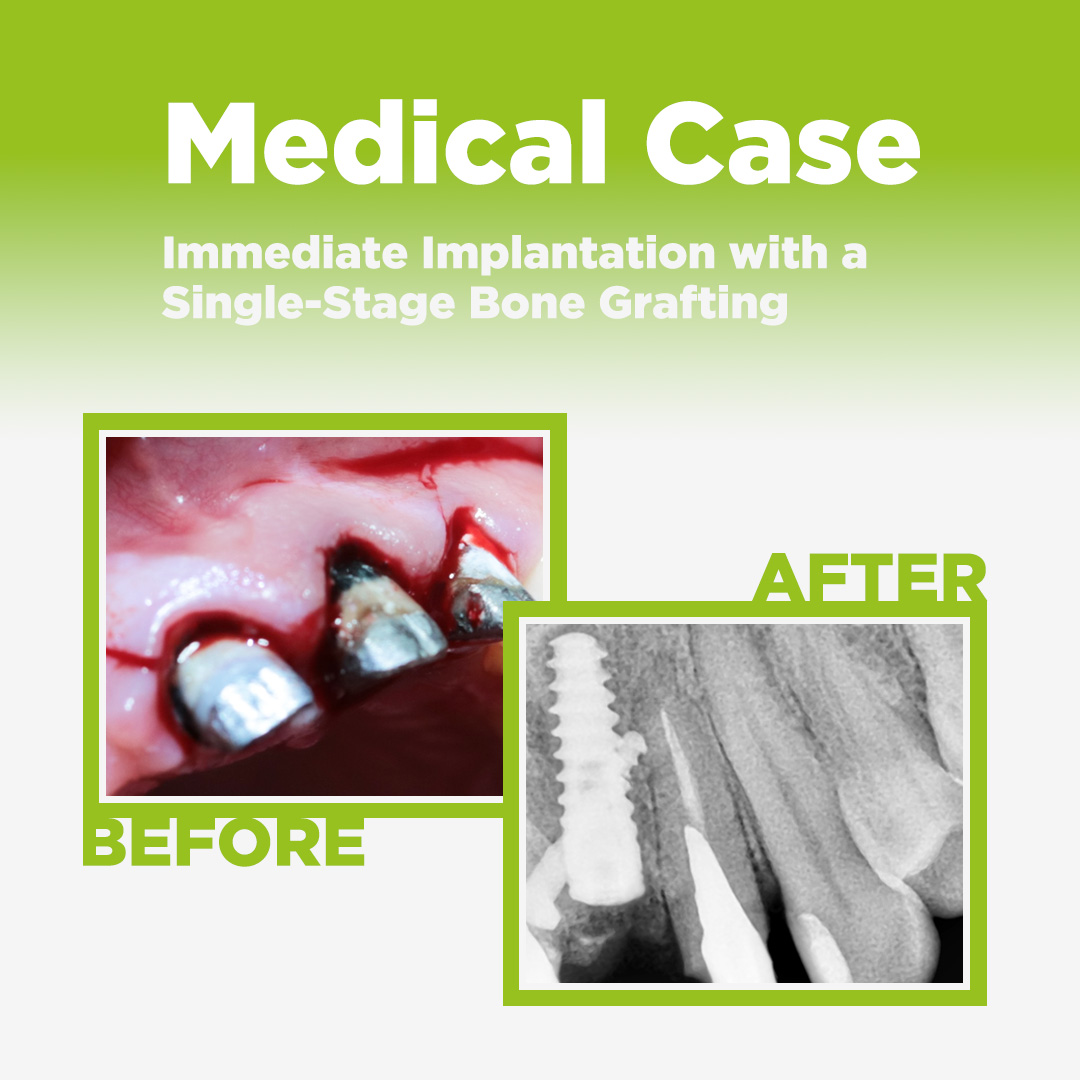 Immediate Implantation