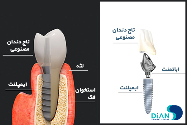 بهترین برند ایمپلنت دندان