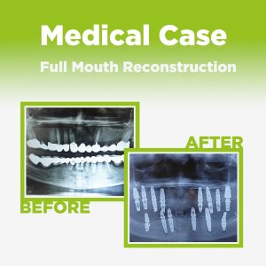 Full Mouth Reconstruction