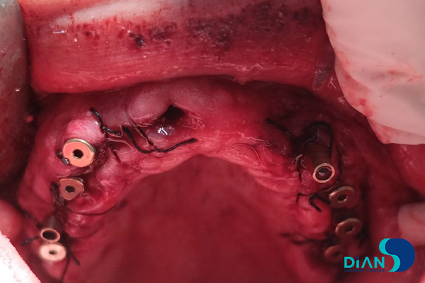 Full Mouth Reconstruction