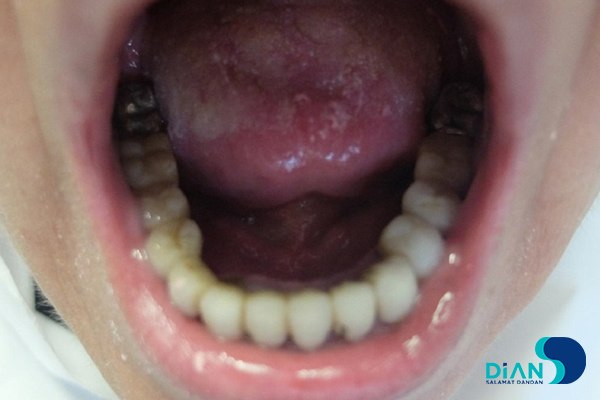 Full Mouth Reconstruction