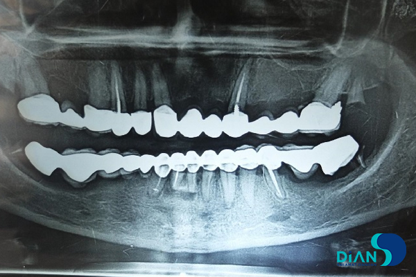 Full Mouth Reconstruction