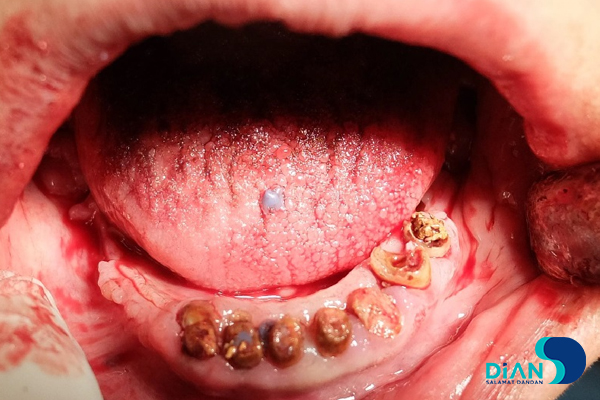 Full Mouth Reconstruction