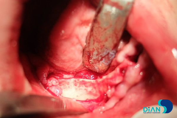 Full Mouth Reconstruction