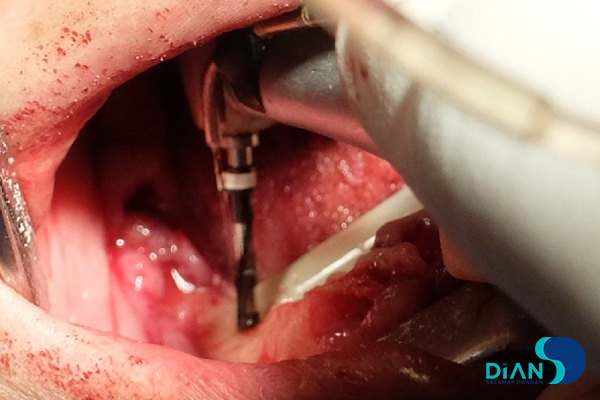 Full Mouth Reconstruction