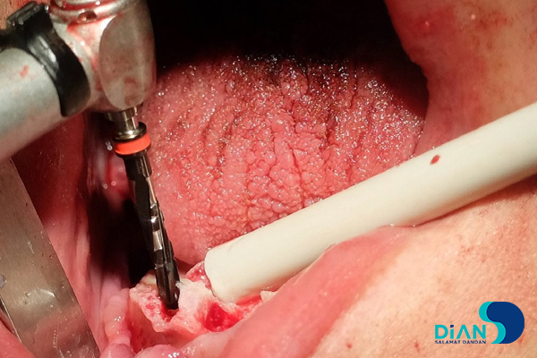 Full Mouth Reconstruction