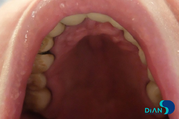 Full Mouth Reconstruction