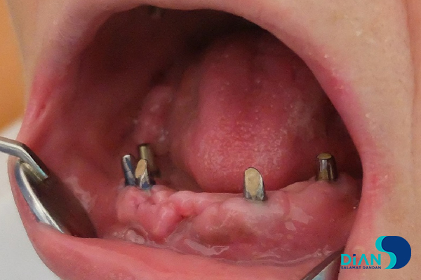 Full Mouth Reconstruction