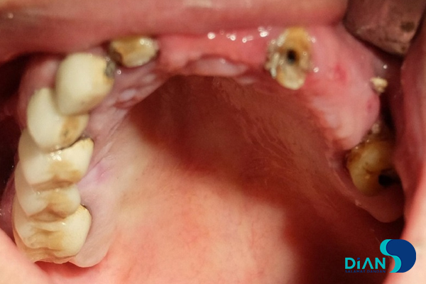 Full Mouth Reconstruction