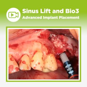 sinus lift surgery