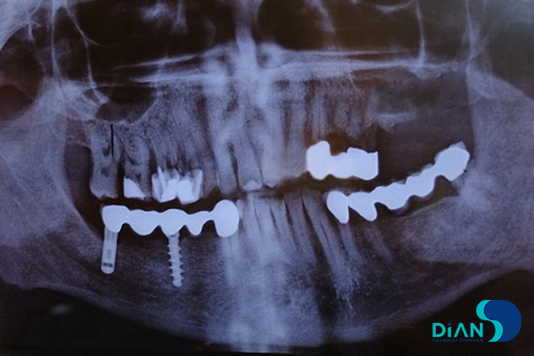 Implantation in Molar