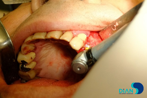 Implantation in Molar