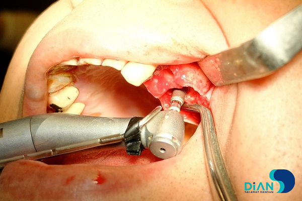 Implantation in Molar