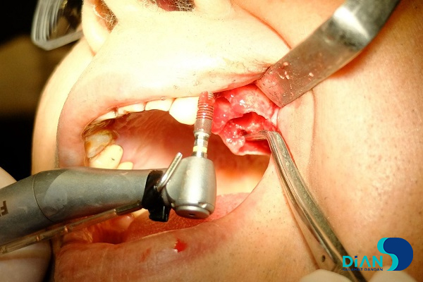 Implantation in Molar