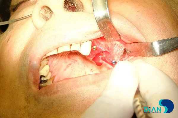 Implantation in Molar