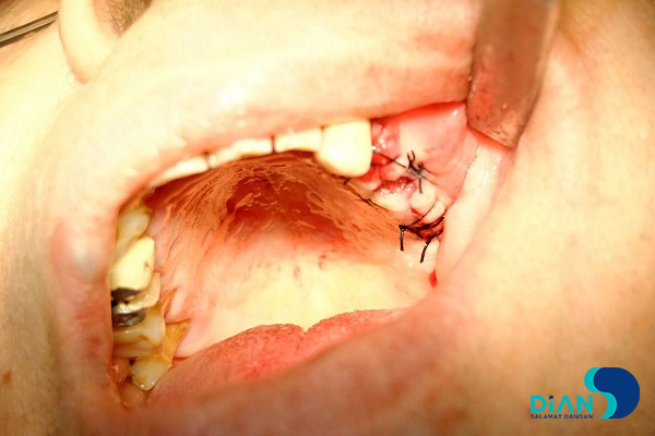 Implantation in Molar