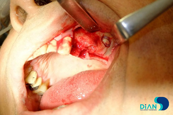 Implantation in Molar