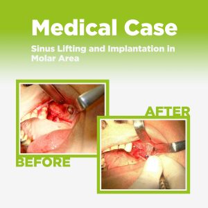 Implantation in Molar