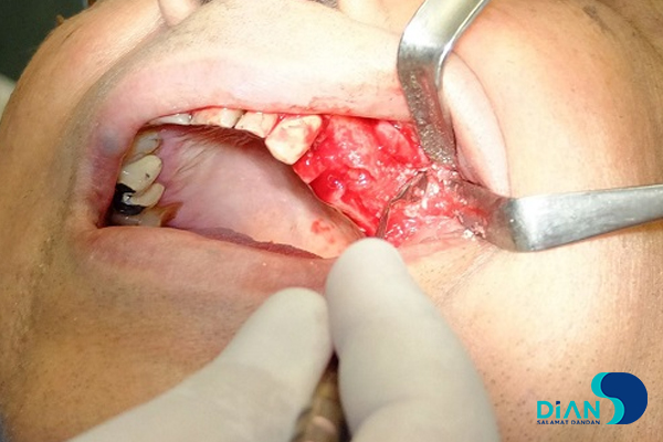 Implantation in Molar