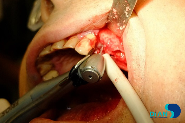 Implantation in Molar