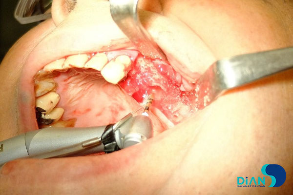 Implantation in Molar